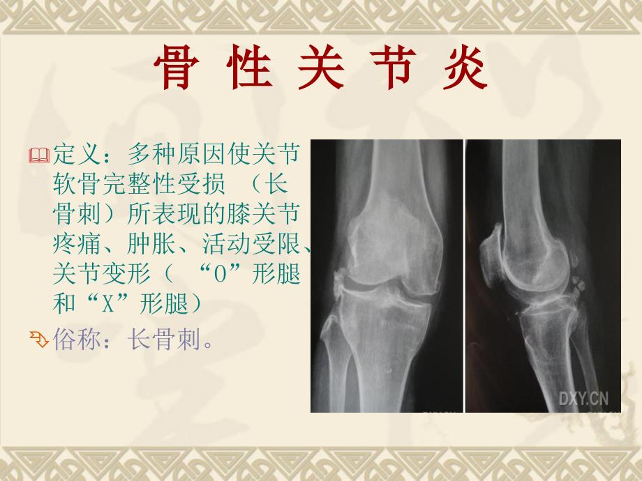 膝关节病健康教育.ppt_第2页