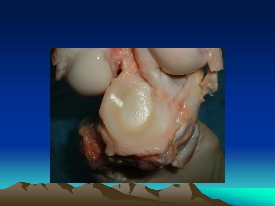 半月板损伤标准PPT课件_第5页