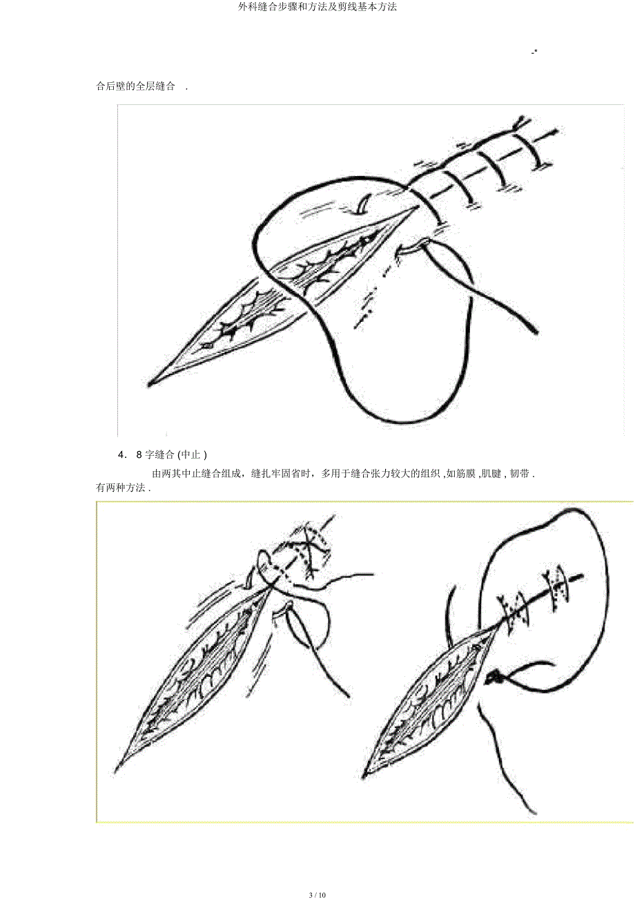 外科缝合步骤和方法及剪线基本方法.docx_第3页