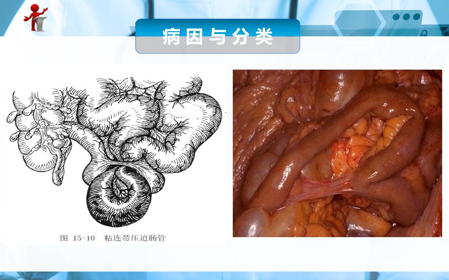 外科护理第五节肠梗阻病人的护理课件_第5页