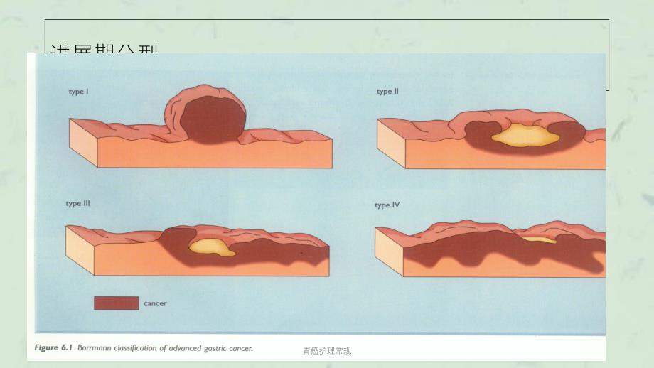 胃癌护理常规课件_第4页