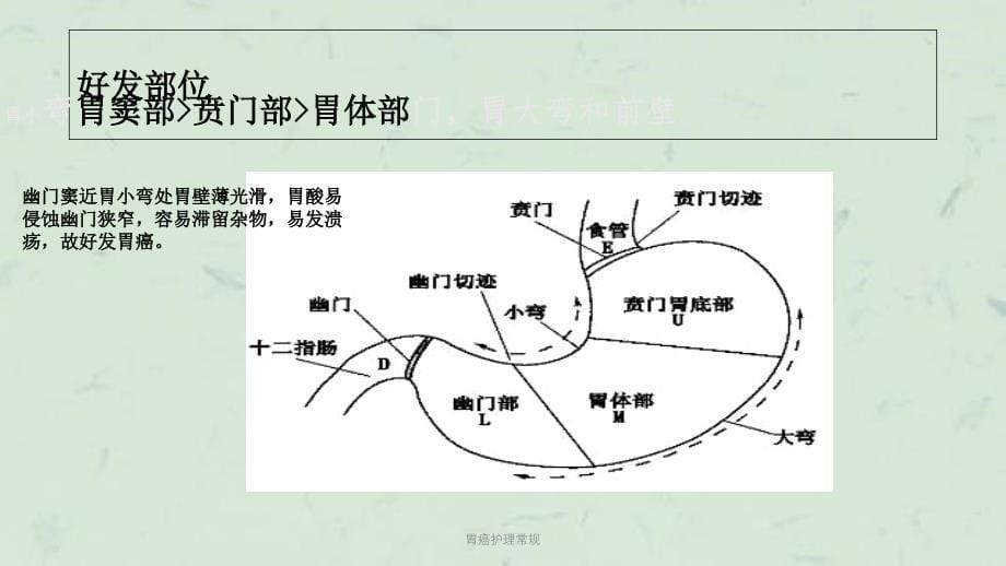 胃癌护理常规课件_第5页