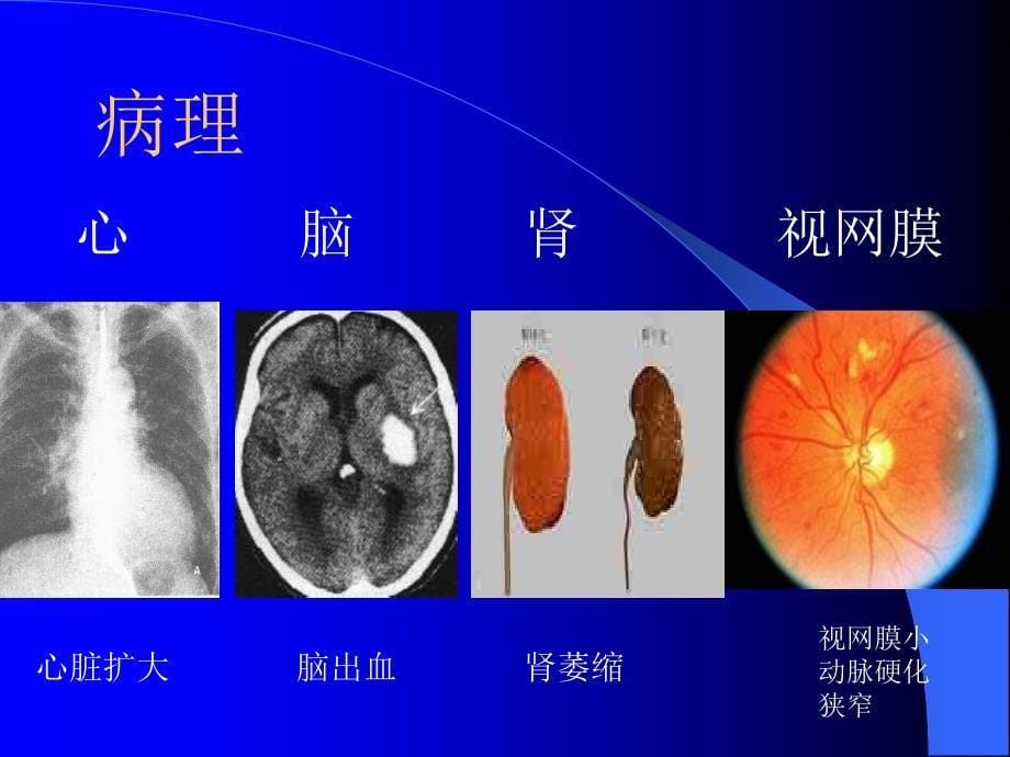 提高班原发性高血压陈建英_第5页