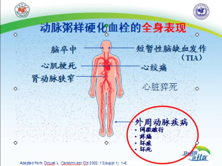 冠心病(课件)_第2页