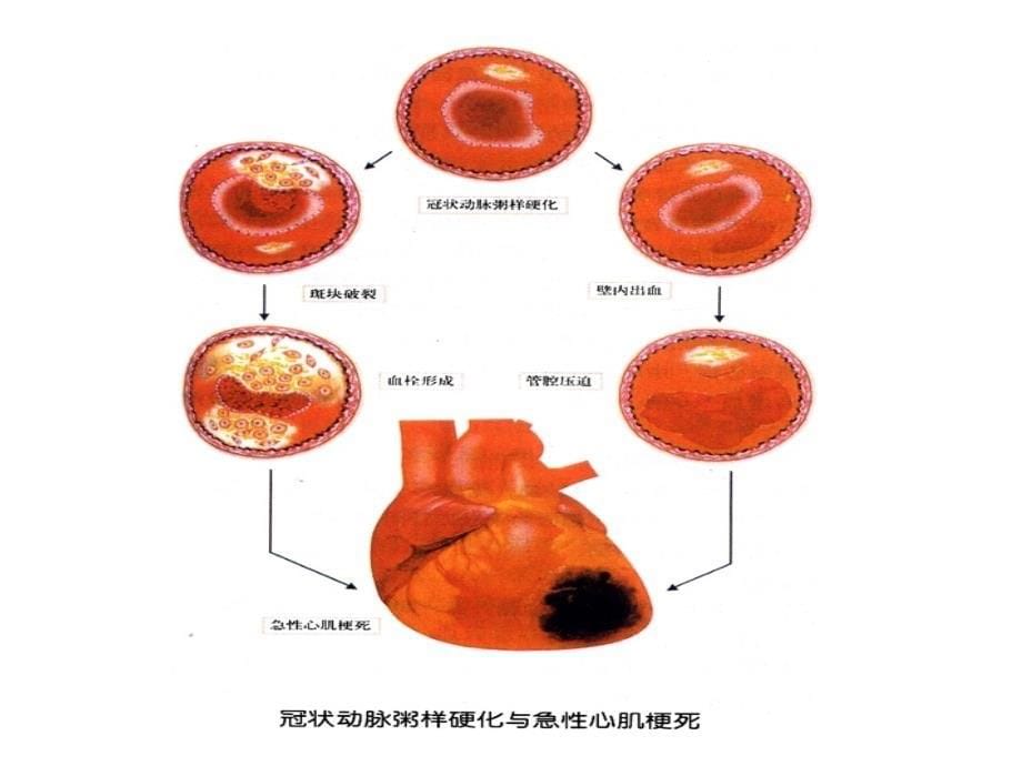 冠心病(课件)_第5页