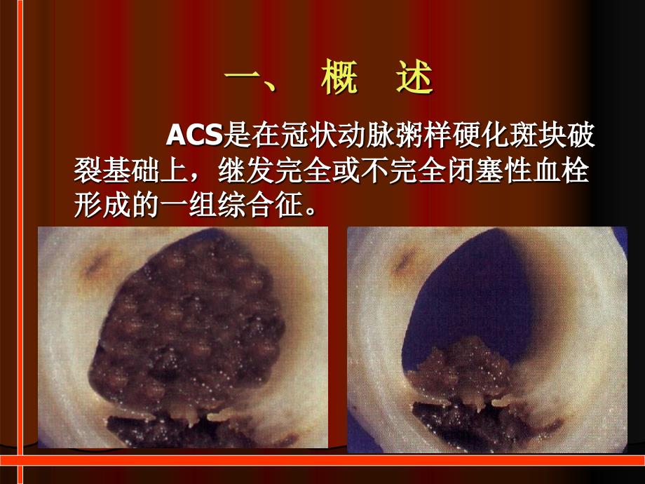 NSTEACS危险分层和治疗策略肖0810_第3页