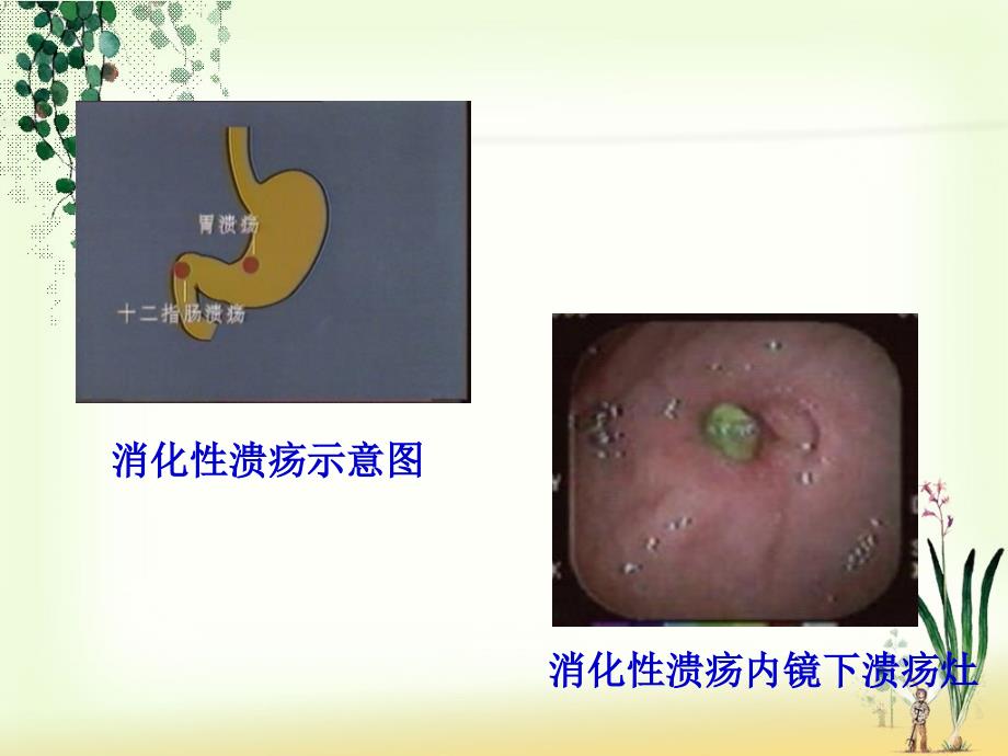 一份消化性溃疡胃镜下表现及护理PPT详解_第4页