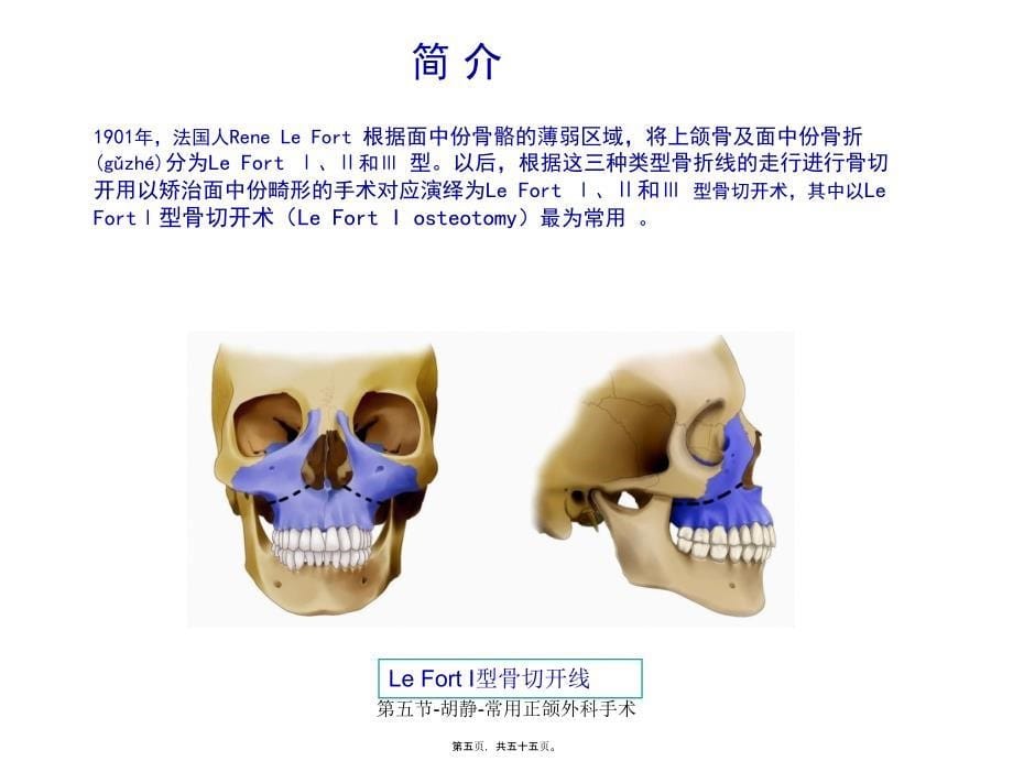 第五节胡静常用正颌外科手术课件_第5页