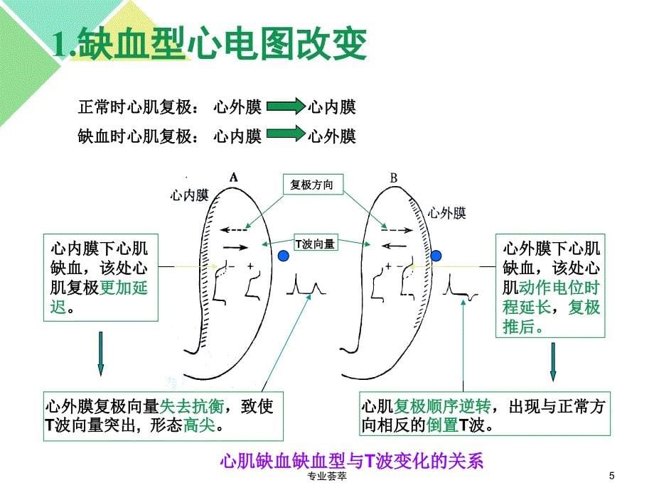 心肌缺血与心肌梗死的心电图特征优质荟萃_第5页