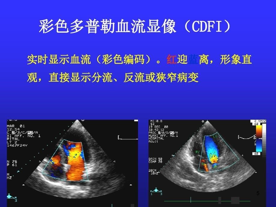 超声心动图结果解ppt课件_第5页