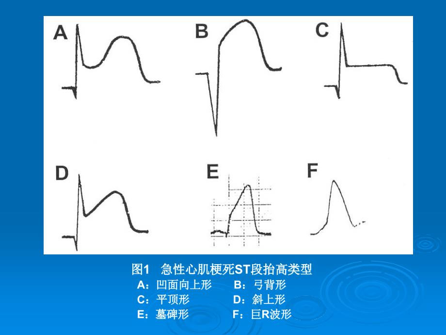 “巨R波形”ST段抬高的特性及其临床意义_第4页