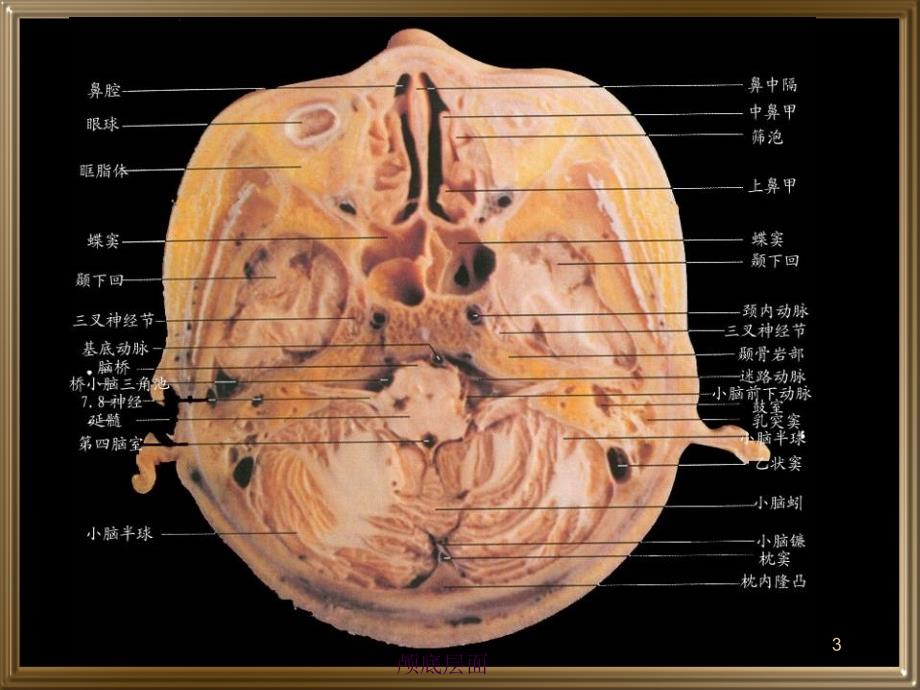 中枢神经系统断层影像ppt课件_第3页