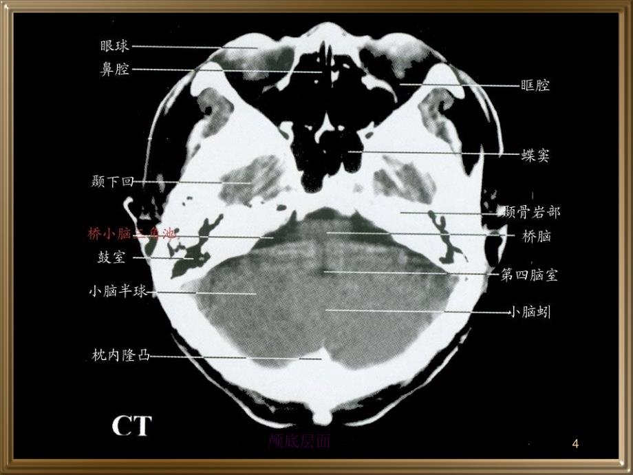 中枢神经系统断层影像ppt课件_第4页