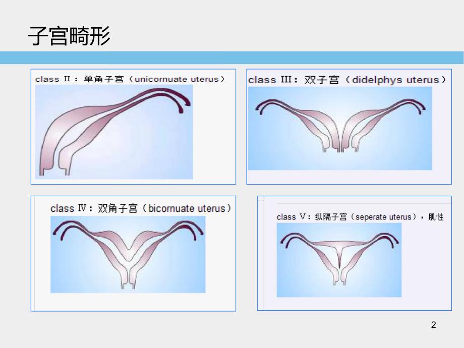 子宫畸形超声诊断标准及思路PPT参考幻灯片_第2页