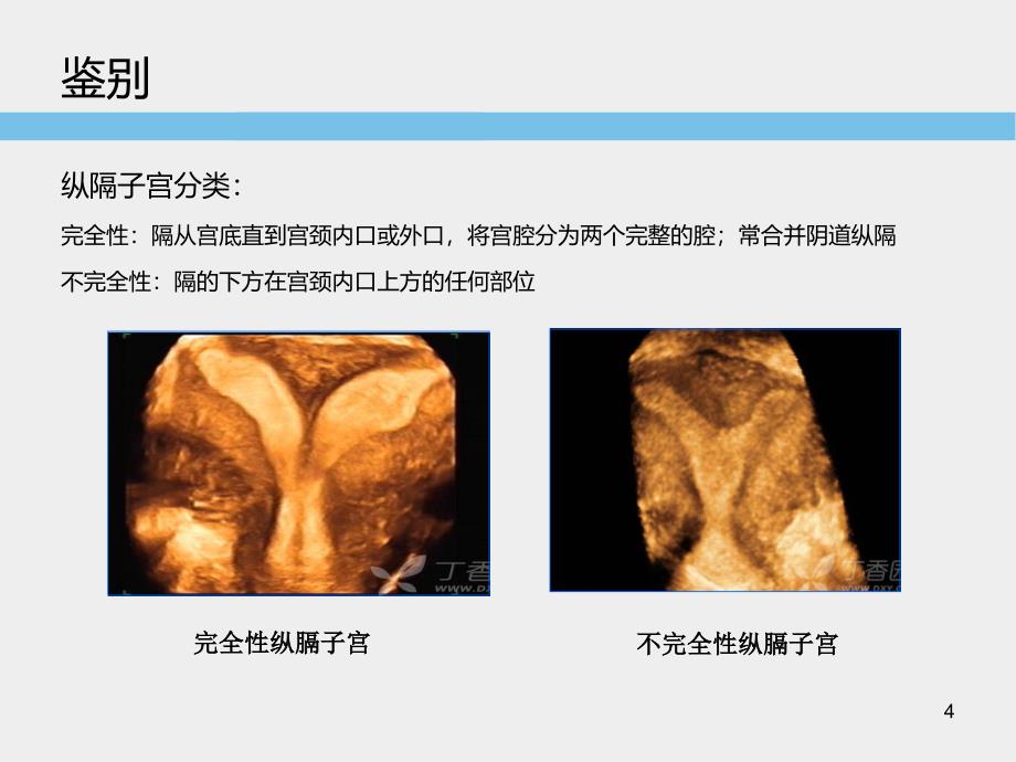 子宫畸形超声诊断标准及思路PPT参考幻灯片_第4页