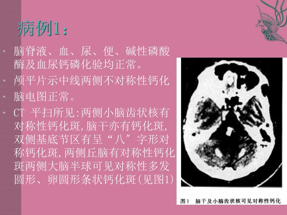 Fahr病汇报PPT课件_第3页