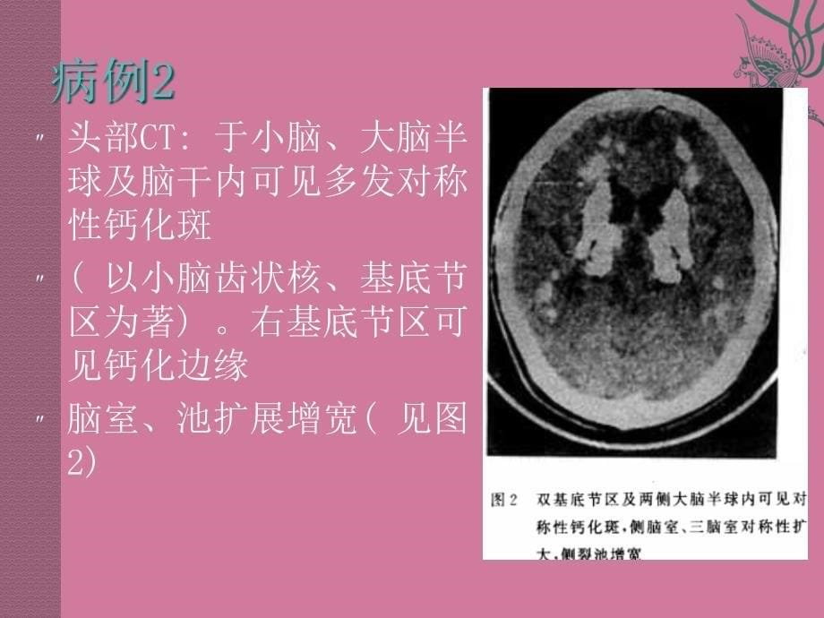 Fahr病汇报PPT课件_第5页