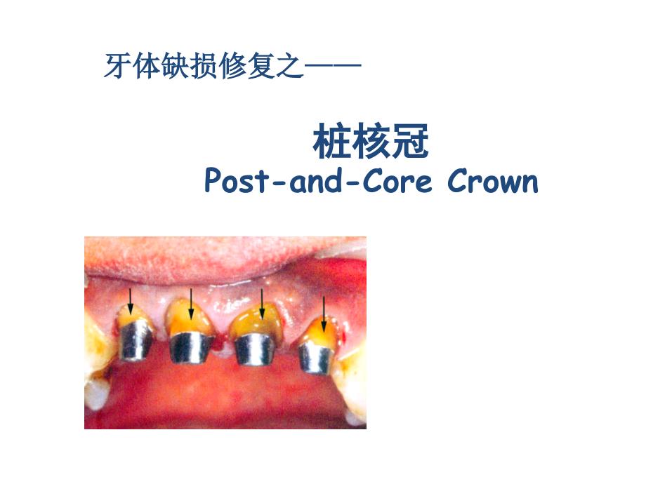 牙体缺损的修复桩核冠课件_第1页