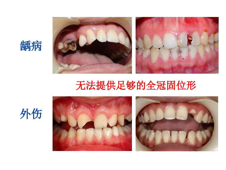 牙体缺损的修复桩核冠课件_第2页