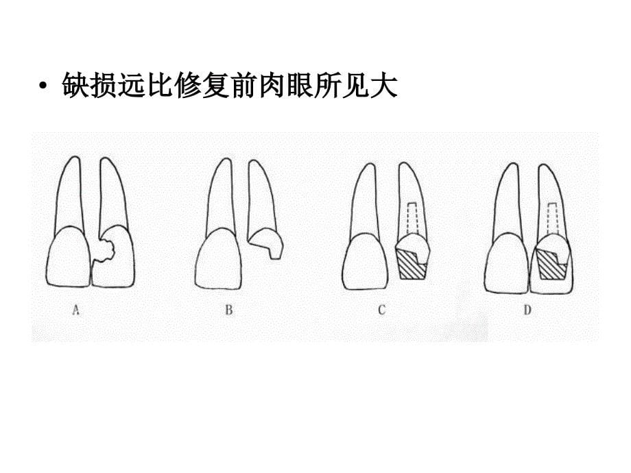 牙体缺损的修复桩核冠课件_第5页