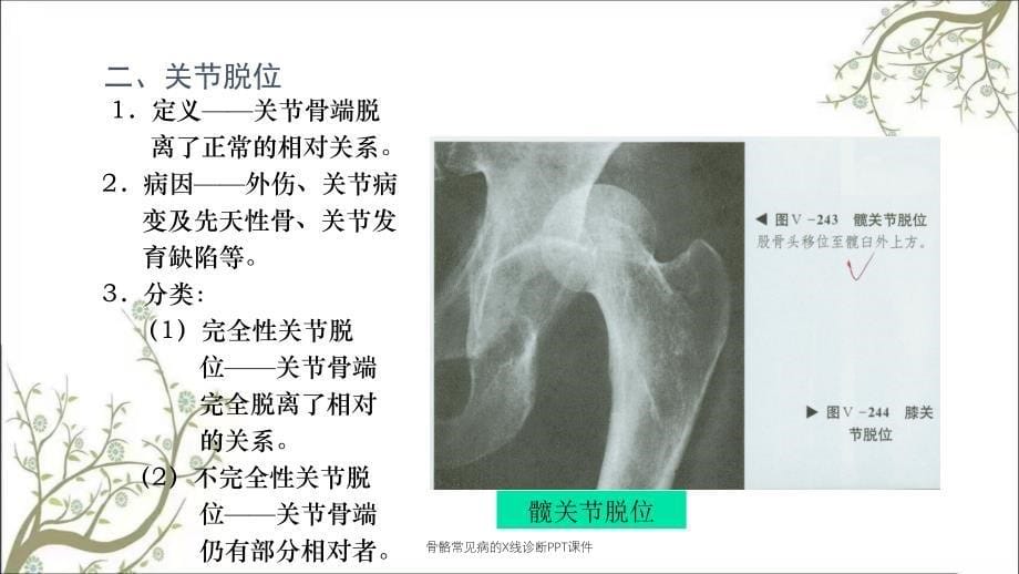 骨骼常见病的X线诊断PPT课件_第5页