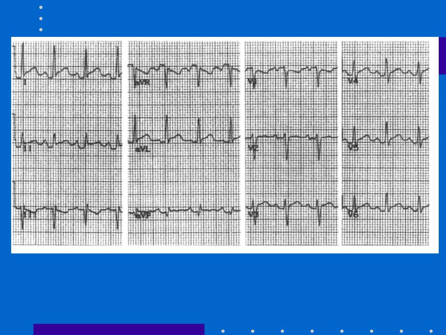 ECG心电图的解读_第2页