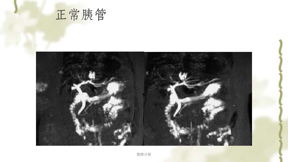 胰腺分裂ppt课件_第4页