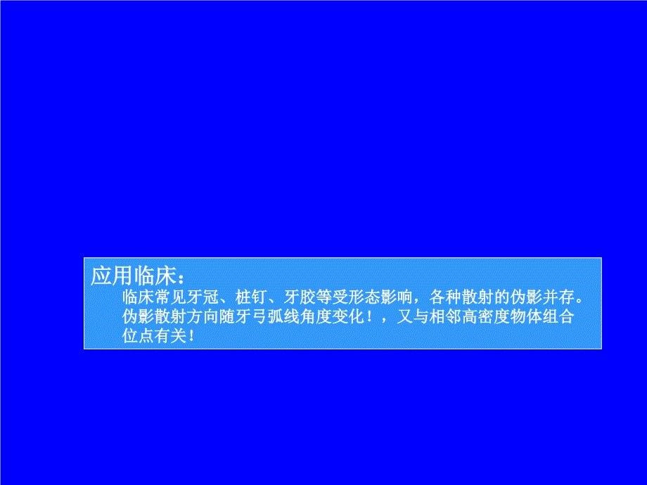 CBCT金属伪影产生的规律研究与临床应用分析课件_第5页