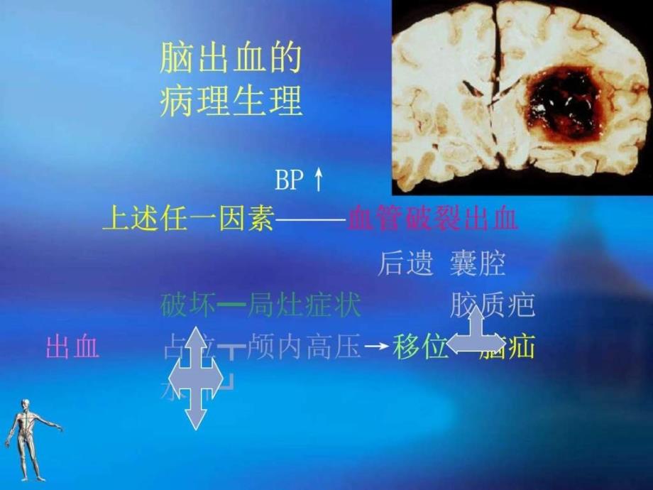 6脑出血图文.ppt16_第3页