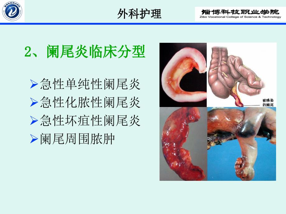 急性阑尾炎实训_第2页