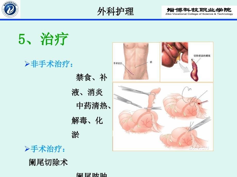 急性阑尾炎实训_第5页