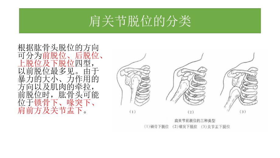 肩关节前脱位介绍_第4页