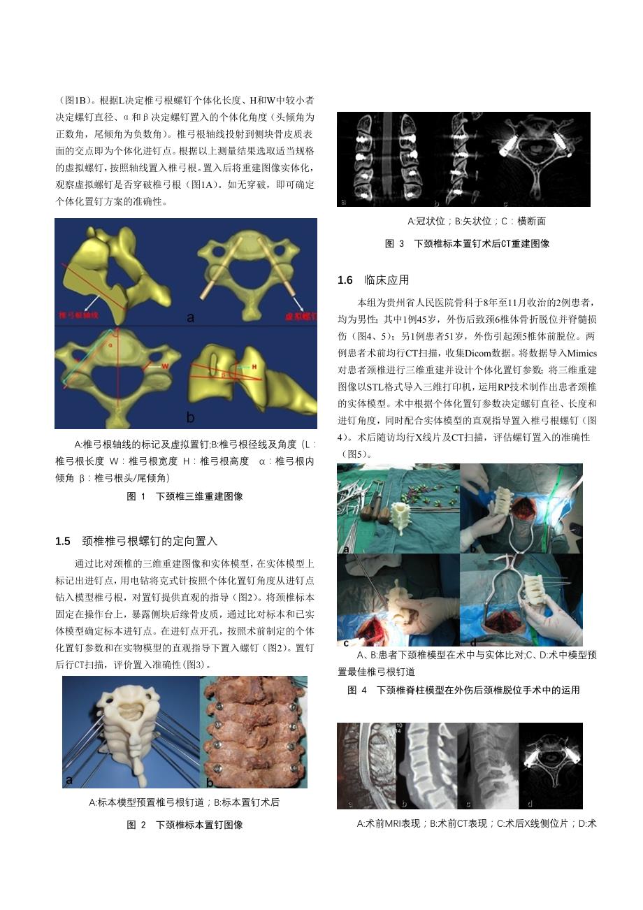 Mimics及脊柱模型用于下颈椎椎弓根个体化置钉的应用研究_第3页