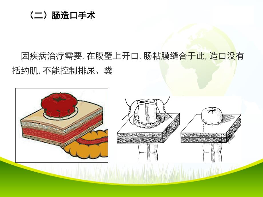 肠造口并发症_第4页