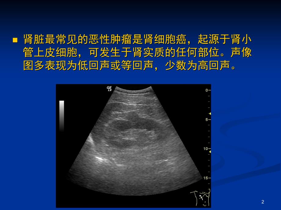 肾脏肿瘤及肿瘤样病变的超声诊断ppt课件_第2页