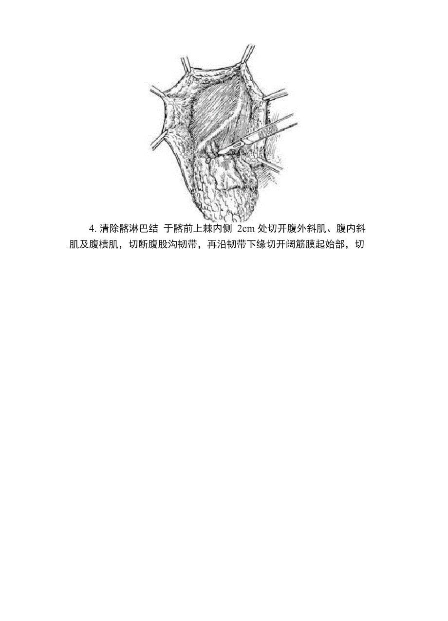 腹股沟淋巴结切除术手术详细步骤腹股沟淋巴结切除术手术过程_第5页