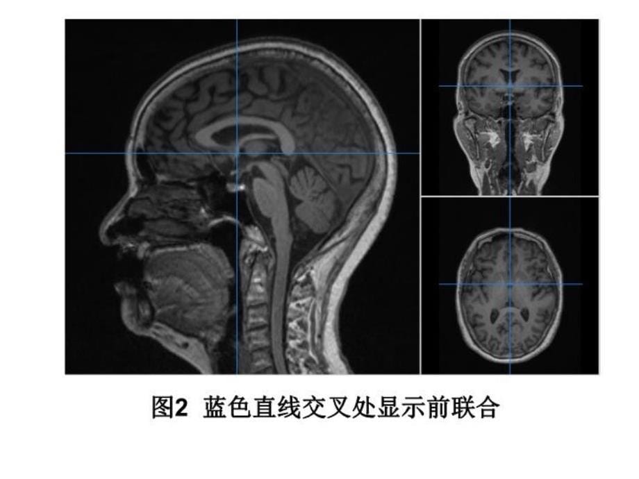 下丘脑影像解剖说课讲解_第5页