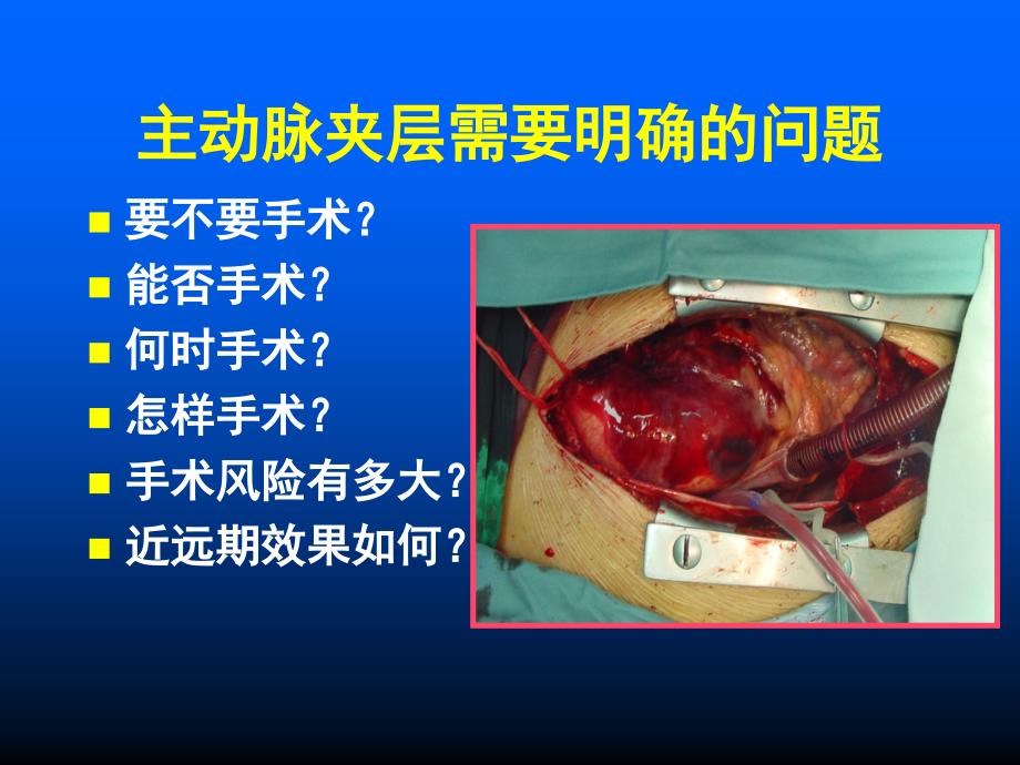 主动脉夹层的外科分型及治疗对策_第4页