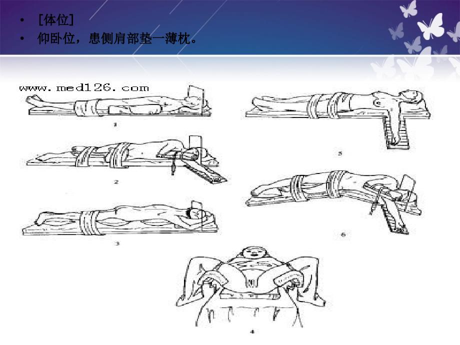 锁骨骨折切开内固定除术护理查房_第4页