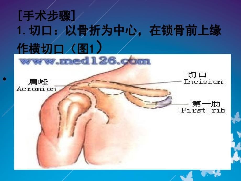 锁骨骨折切开内固定除术护理查房_第5页