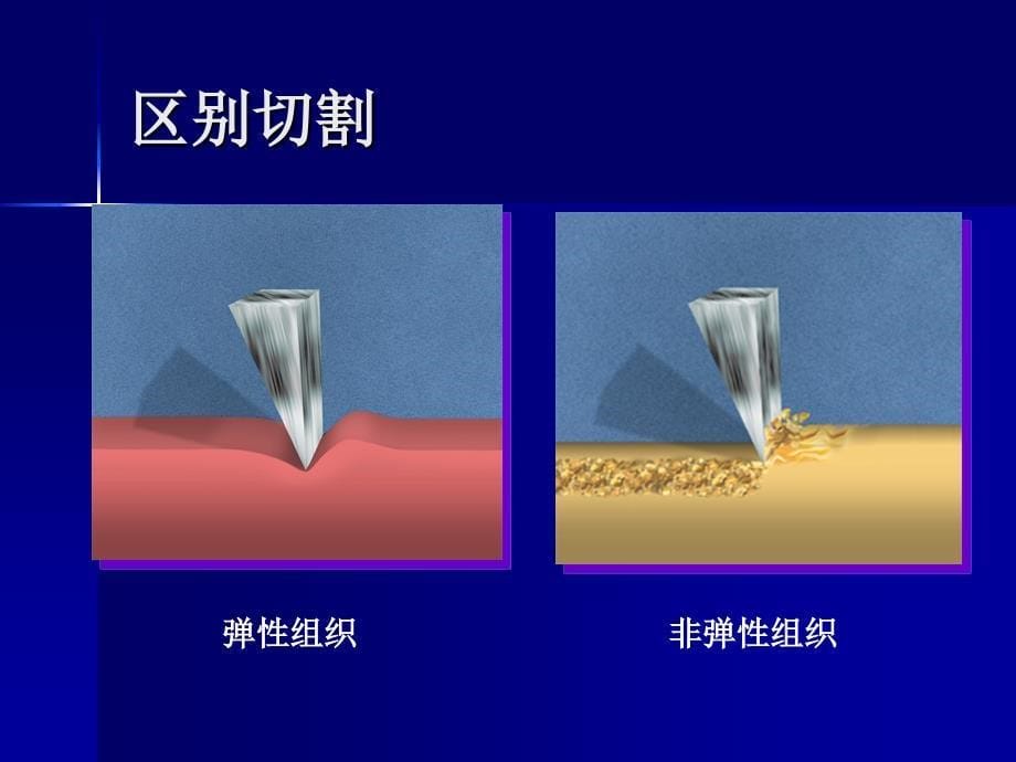 旋磨技术的原理和监护常规_第5页