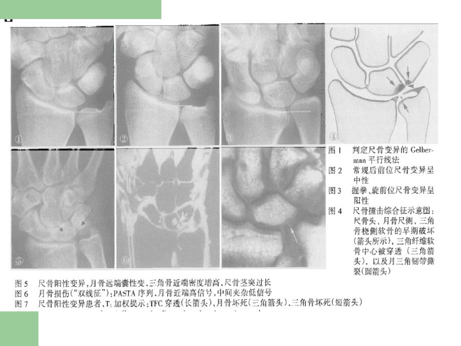 尺骨撞击综合征的特点及早期诊断_第4页