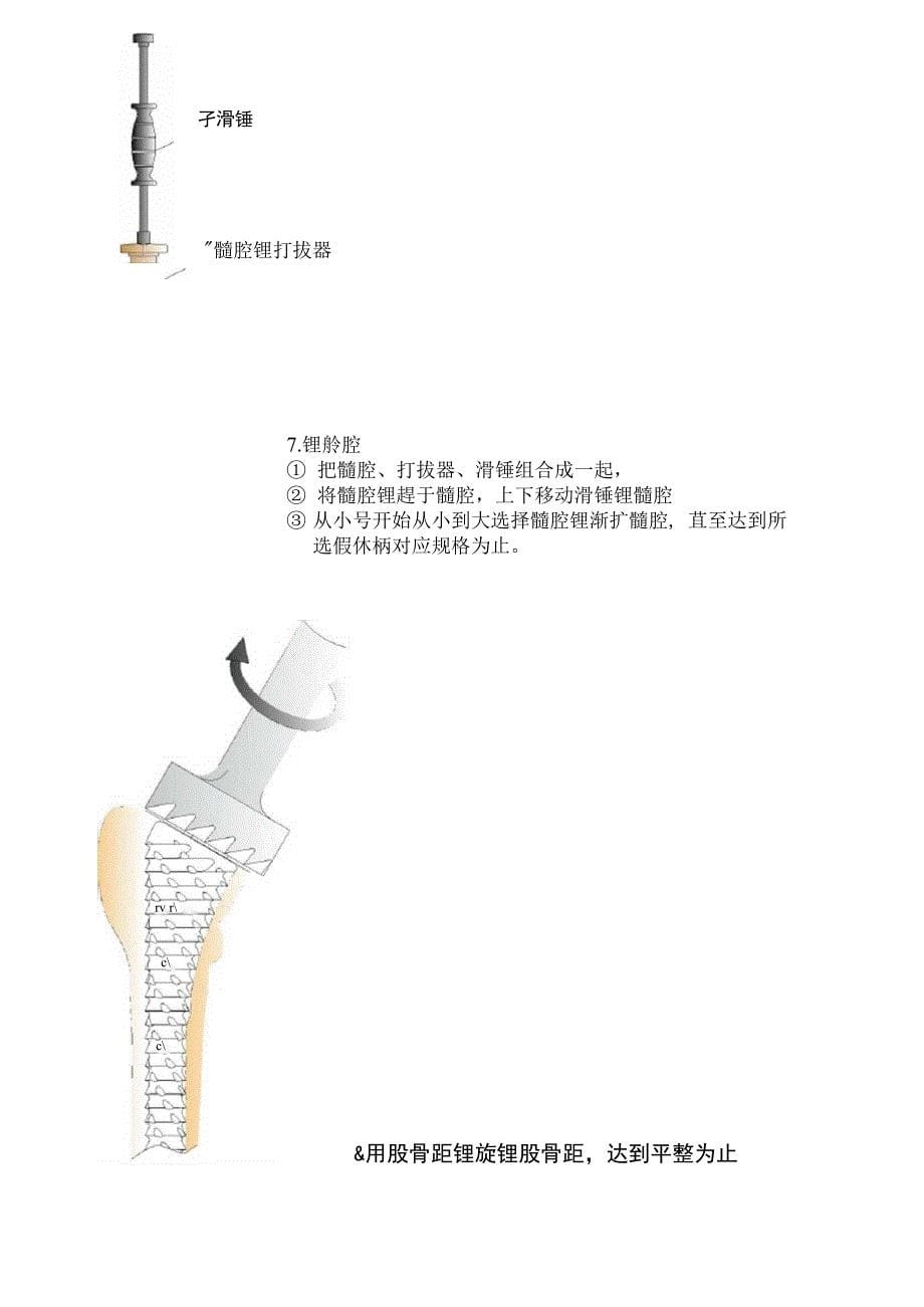 髋关节置换手术操作流程审批稿_第5页