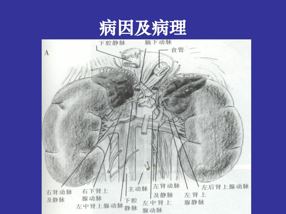 左肾静脉受压综合征_第3页