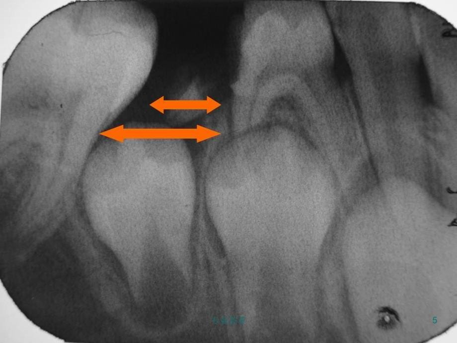 牙髓病与根尖周病课件优质荟萃_第5页