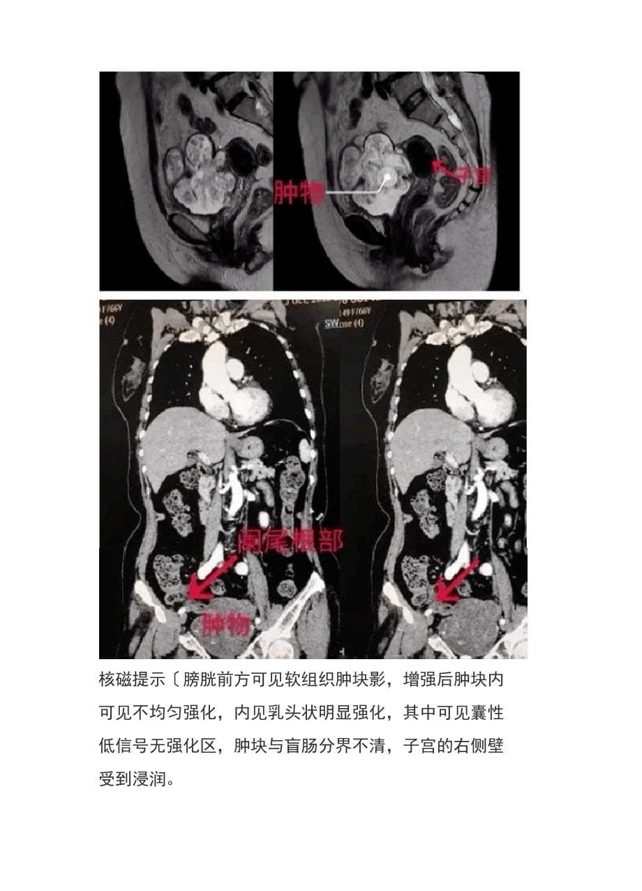 14阑尾黏液腺癌_第5页