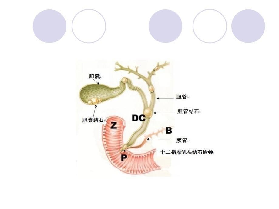 胆管癌的个案查房_第5页