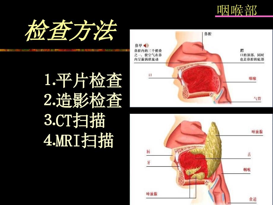 鼻咽及喉部影像学诊断_第3页