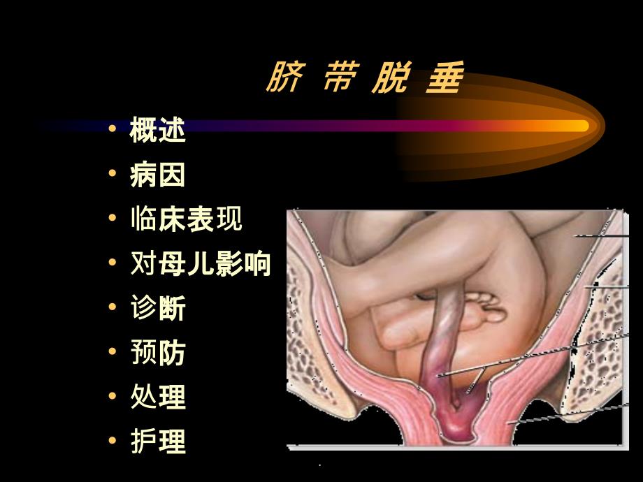 脐带脱垂完整ppt课件_第2页