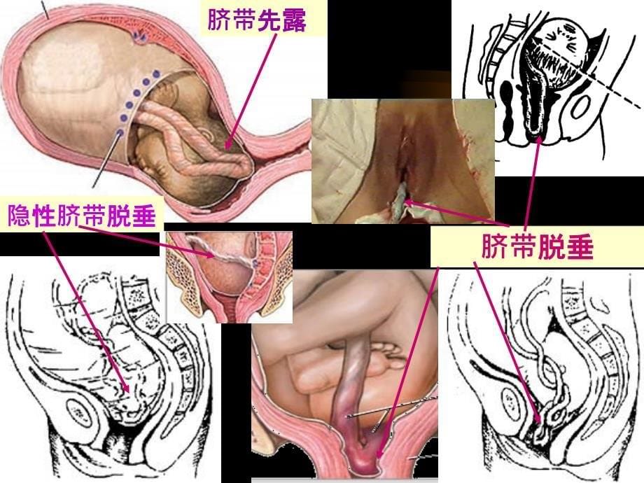 脐带脱垂完整ppt课件_第5页